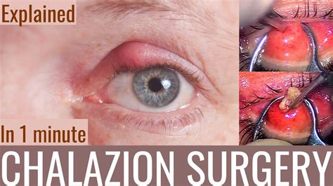 Treatment of Chalazion: Quick Surgery without Pain or Scars. - YouTube