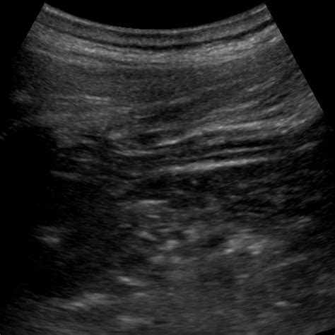 Ultrasound-guided quadratus lumborum block at the lateral supra-arcuate ...