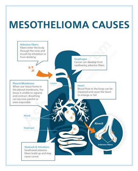 Mesothelioma Causes & Risk Factors: Asbestos Exposure