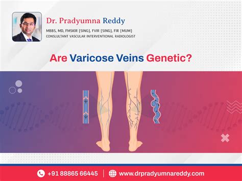 Are Varicose Veins Genetic