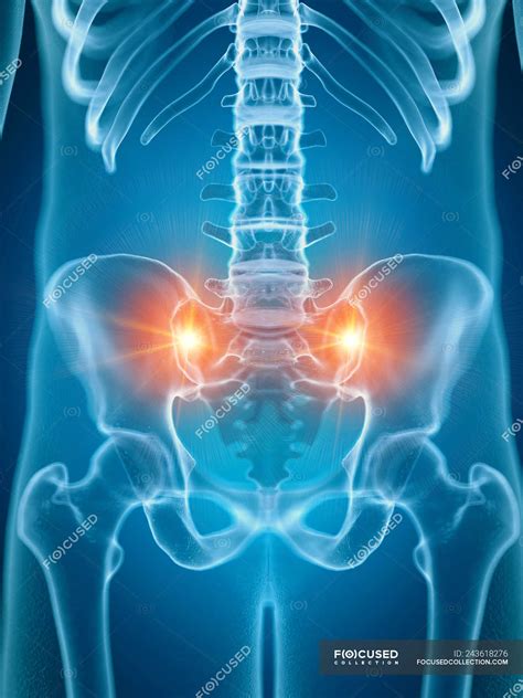 Illustration of painful sacrum joints in human skeleton part. — pelvic bone, rheumatism - Stock ...