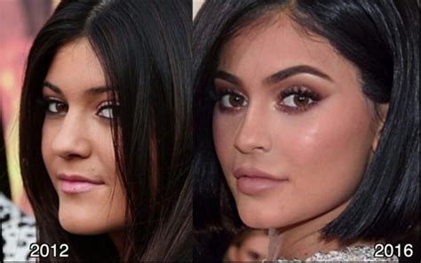 Kylie Jenner Before and After ? All of her Plastic Surgery!