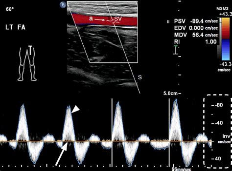 Color and pulsed-wave Doppler sonograms of normal lower extremity ...