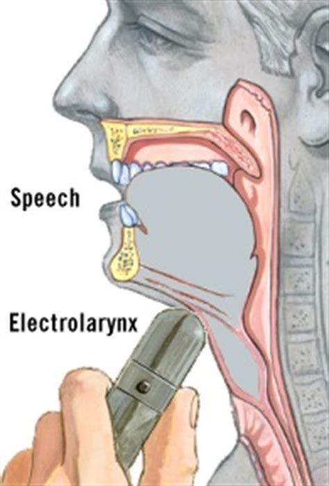 Learning to Speak Again After Laryngeal Surgery - Health Encyclopedia ...