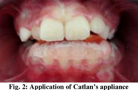 Figure 4 from Use of Catlan's Appliance to Correct Anterior Crossbite ...