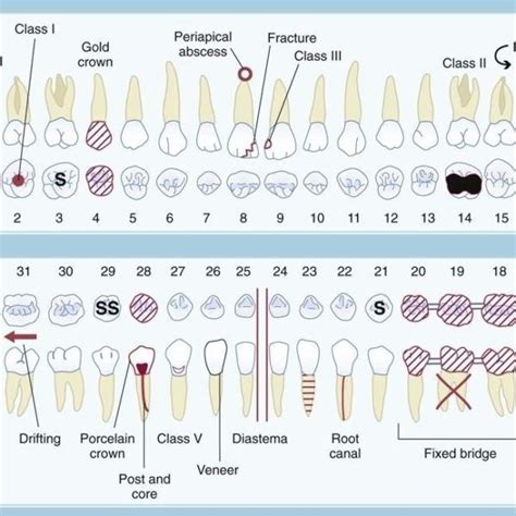 Dental Charting Symbols | World Of Template & Format throughout Dental Charting Symbols | Dental ...