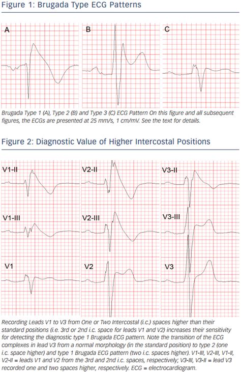 The Brugada Syndrome – Diagnosis, Clinical Implications and Risk Stratification | ECR Journal