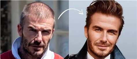 David Beckham Before and After Plastic Surgery Journey - Vanity