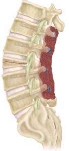 Pedicle Subtraction Osteotomy (PSO) - Matthew D. Hepler, M.D.