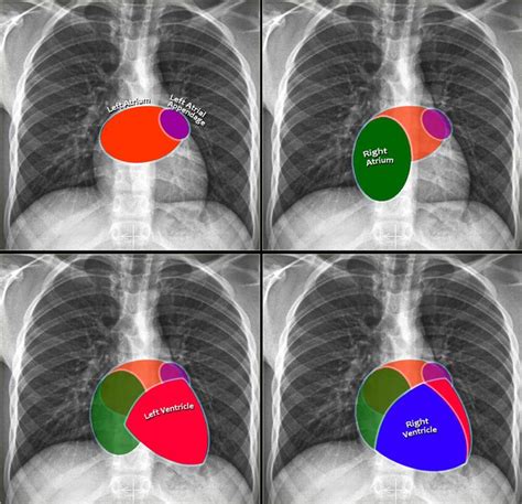 CXR Heart | Radiology, Cardiac anatomy, Radiology imaging