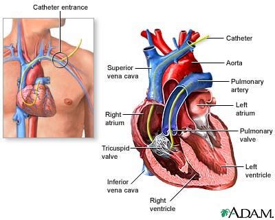 Swan Ganz catheterization: MedlinePlus Medical Encyclopedia Image