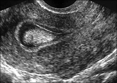 Endometrial Cysts On Ultrasound