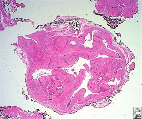 Pathology showing malformed blood vessels of intercommunicating ...