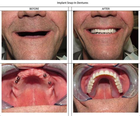 Snap In Dentures Mexicali | Implants | Ballesteros | Afforable