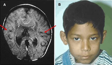 Holoprosencephaly causes, diagnosis, prognosis and treatment