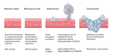 Colorectal Cancer | Concise Medical Knowledge