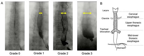 JCM | Free Full-Text | Clinical Risk Factors for Dysphagia and ...