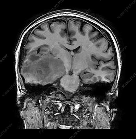 Glioblastoma Temporal Lobe, MRI - Stock Image - C039/3940 - Science Photo Library