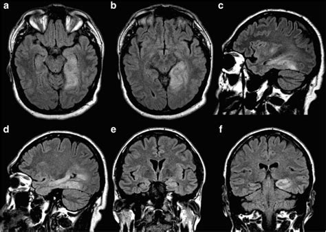 Preoperative MRI of a 53-year-old male complaining of seizures. a, b... | Download Scientific ...