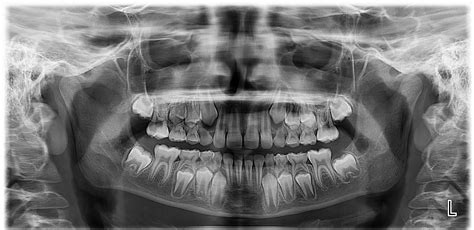 X-ray of 9 year old teeth