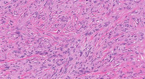 Dermatofibroma - MyPathologyReport.ca