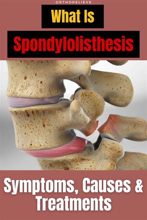 Spondylolisthesis symptoms causes and treatments – Artofit