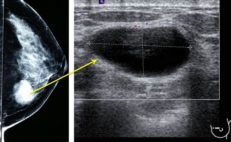 Simple breast cyst – Radiology Cases