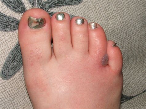 Gallery of Skin Boil Pictures and Other Infections