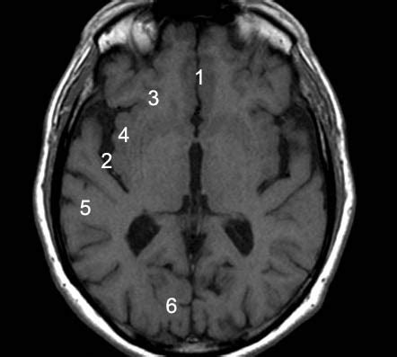 The anatomy of the brain’s lobes with MRI | Eurorad