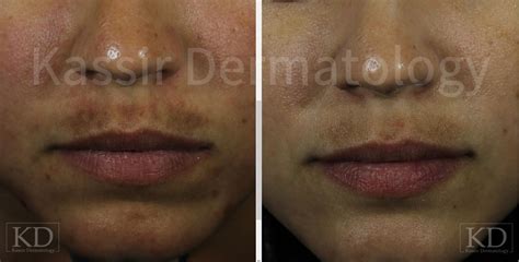 How To Reduce Pigmentation Above Lips | Lipstutorial.org