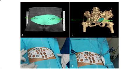 (a) (b) Preoperative simulation of seeds implantation assisted with ...