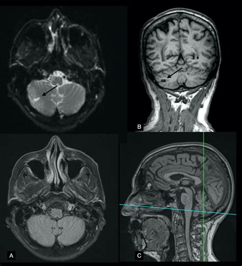 Cureus | Brainstem Stroke Presenting as Wake-Up Diplopia in a Patient ...