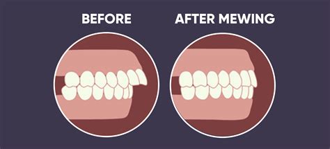 How Can Mewing Fix Overbite | Mewing.coach