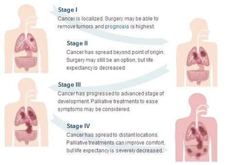 gumoti: Mesothelioma life expectancy after diagnosis