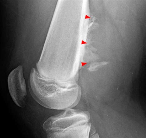 Myositis Ossificans | Radsource