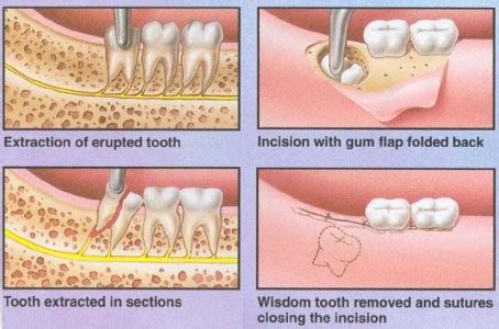 Wisdom Teeth Removal | Wisdom Tooth Surgery Singapore - GardenDental