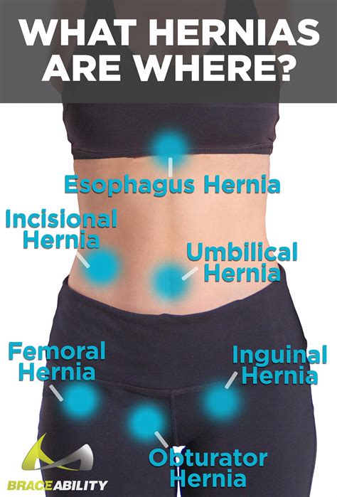 Best Abdominal Hernia Treatment Support Belt for Women #abexercises | Umbilical hernia ...