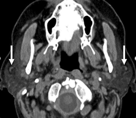 Axial CT demonstrates normal parotid lymph nodes often seen within this... | Download Scientific ...