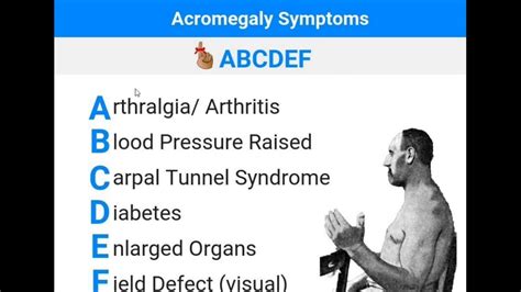 Acromegaly Symptoms Neumonic Picture , Easy To Remember - YouTube