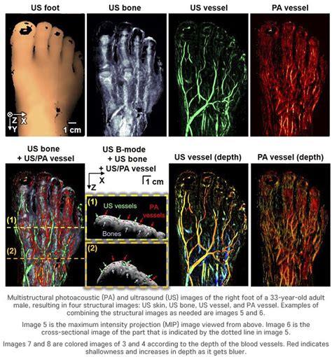 3D bimodal photoacoustic ultrasound imaging to diagnose peripheral ...