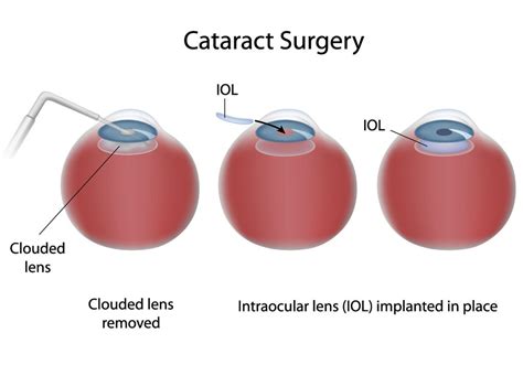 Cataract Surgery and Glaucoma - Glaucoma Associates of Texas