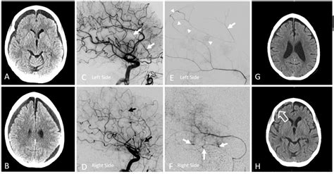 MMA Embolization Bilateral Recurrent Meningeal Arteries | neuroangio.org