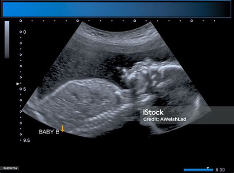 Identical Twin Boy Obstetrical Ultrasound Stock Photo - Download Image ...