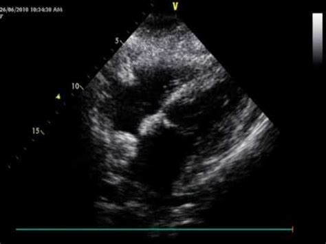 lipomatous hypertrophy of the interatrial septum:case two.subcostal view - YouTube