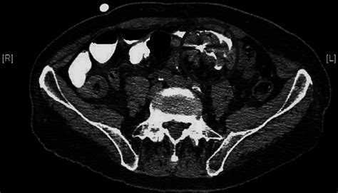 CT image of the lower abdomen showing the tip of the enteroclysis... | Download Scientific Diagram