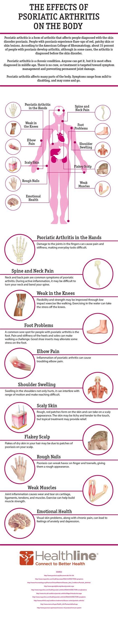 Psoriatic Arthritis at OSR