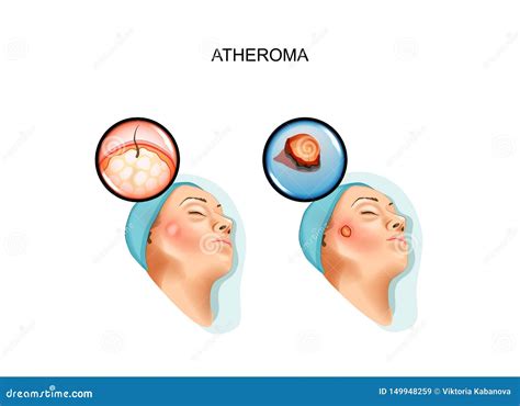 Surgery of Benign Tumors of Atheroma Stock Illustration - Illustration of boil, abscess: 149948259