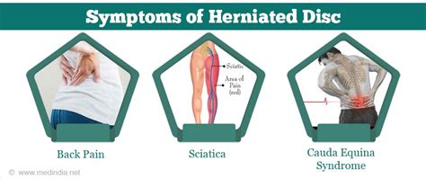 Herniated Disc Symptoms