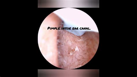 Pimple inside ear canal - YouTube