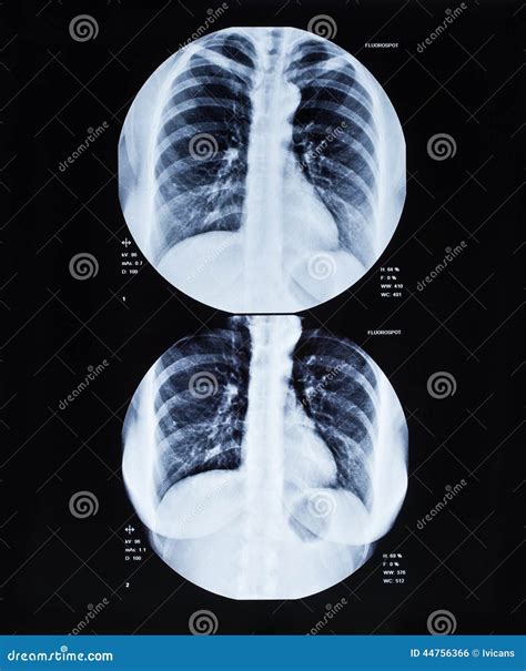 X-Ray Image Of Human Chest stock photo. Image of health - 44756366